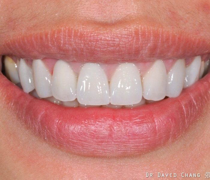 陶瓷貼片案例 1 - 全方位牙齒美學權威 張智洋醫師