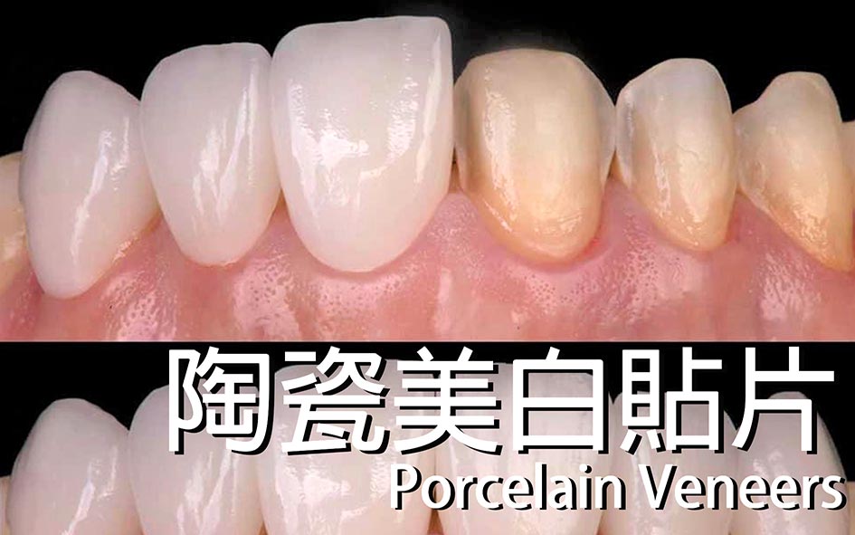 Porcelain-Veneers-陶瓷貼片案例-全方位牙齒美學權威-張智洋醫師