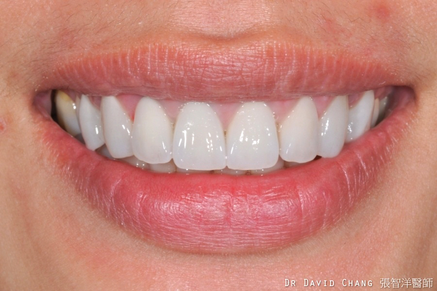 陶瓷貼片案例 1 - 全方位牙齒美學權威 張智洋醫師