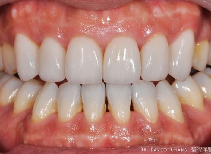 陶瓷貼片案例2 - 全方位牙齒美學權威 張智洋醫師
