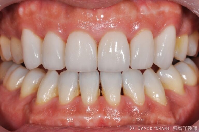 陶瓷貼片案例2 - 全方位牙齒美學權威 張智洋醫師