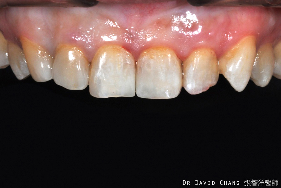 陶瓷貼片案例3 側門牙，虎牙 - 全方位牙齒美學權威 張智洋醫師