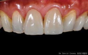 陶瓷貼片案例3 - 全方位牙齒美學權威 張智洋醫師
