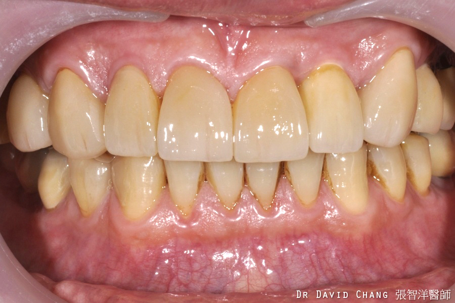 陶瓷貼片＋植牙 - 全方位牙齒美學權威 張智洋醫師