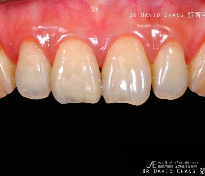 顯微陶瓷貼片 - 全方位牙齒美學權威 張智洋醫師