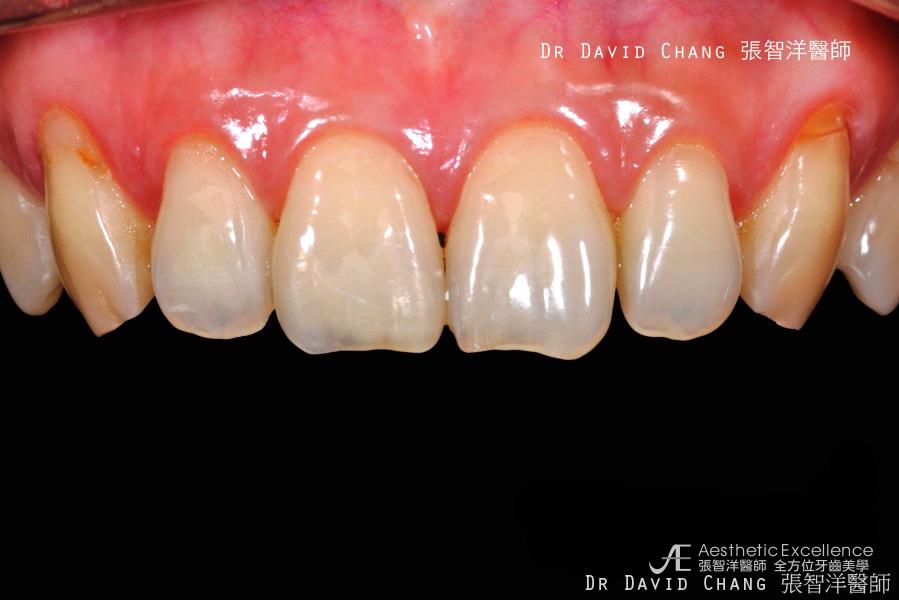 顯微陶瓷貼片 - 全方位牙齒美學權威 張智洋醫師