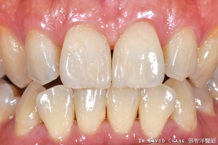 顯微陶瓷貼片2 - 全方位牙齒美學權威 張智洋醫師