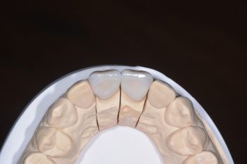 全瓷冠製作過程,展現自然透光性