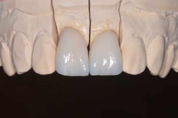 全瓷冠製作過程,展現自然透光性