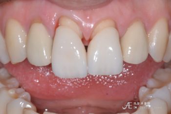 兩顆門牙全瓷冠的案例g 全方位牙齒美學權威 張智洋醫師