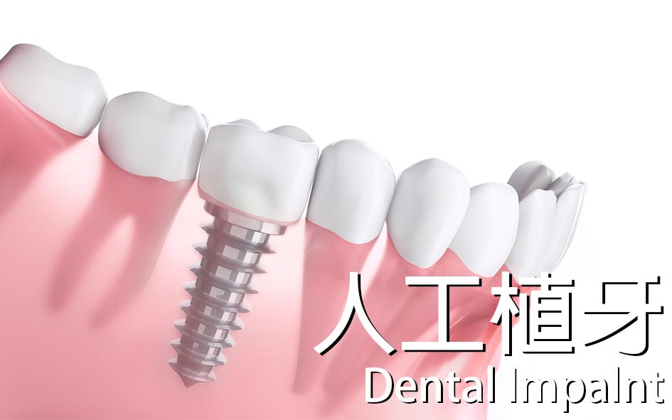 DIental-Implants-人工植牙-全方位牙齒美學權威-張智洋醫師
