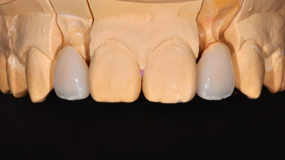 _DSC0030陶瓷貼片介紹6-全方位牙齒美學權威-張智洋醫師