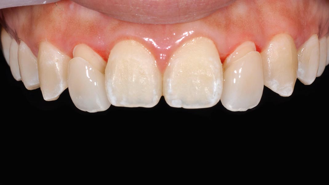 _DSC0057陶瓷貼片介紹1-全方位牙齒美學權威-張智洋醫師