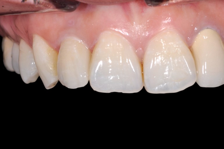 _DSC0328 前牙美學植牙h 全方位牙齒美學權威 張智洋醫師(2)