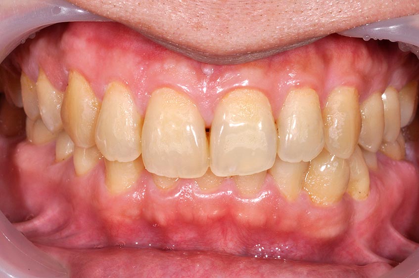 _DSC1035 牙齒美白案例四a 美白前-全方位牙齒美學權威 張智洋醫師