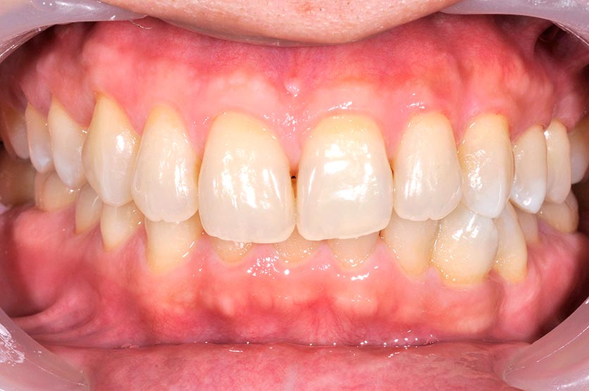 _DSC1081 牙齒美白案例四f 美白後 -全方位牙齒美學權威 張智洋醫師