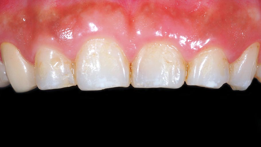 DSC_0036陶瓷貼片介紹5-全方位牙齒美學權威-張智洋醫師