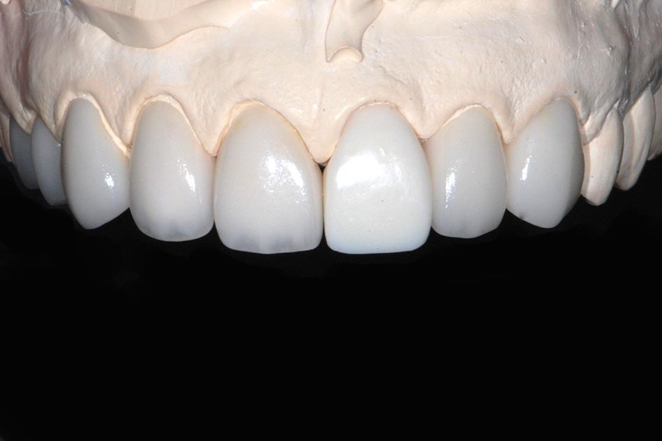陶瓷美白貼片Porcelain Veneers - 全方位牙齒美學權威張智洋醫師
