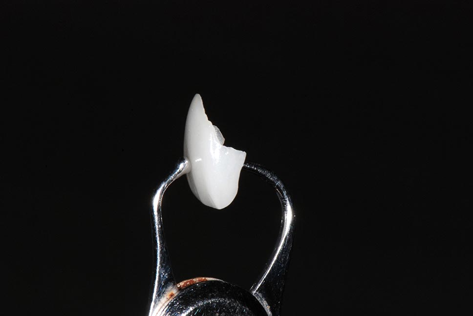 DSC_0273陶瓷貼片介紹9-全方位牙齒美學權威-張智洋醫師