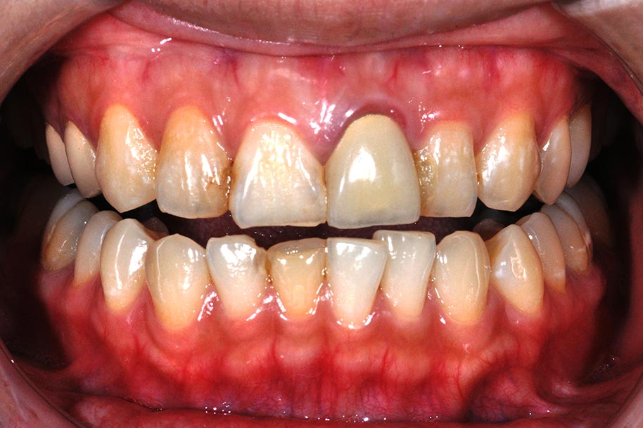 DSC_1111-美容牙科-全方位牙齒美學權威-張智洋醫師