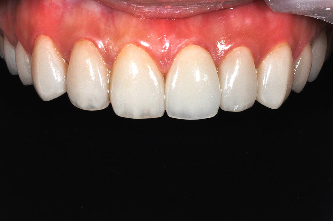 DSC_2244陶瓷貼片介紹10-全方位牙齒美學權威-張智洋醫師