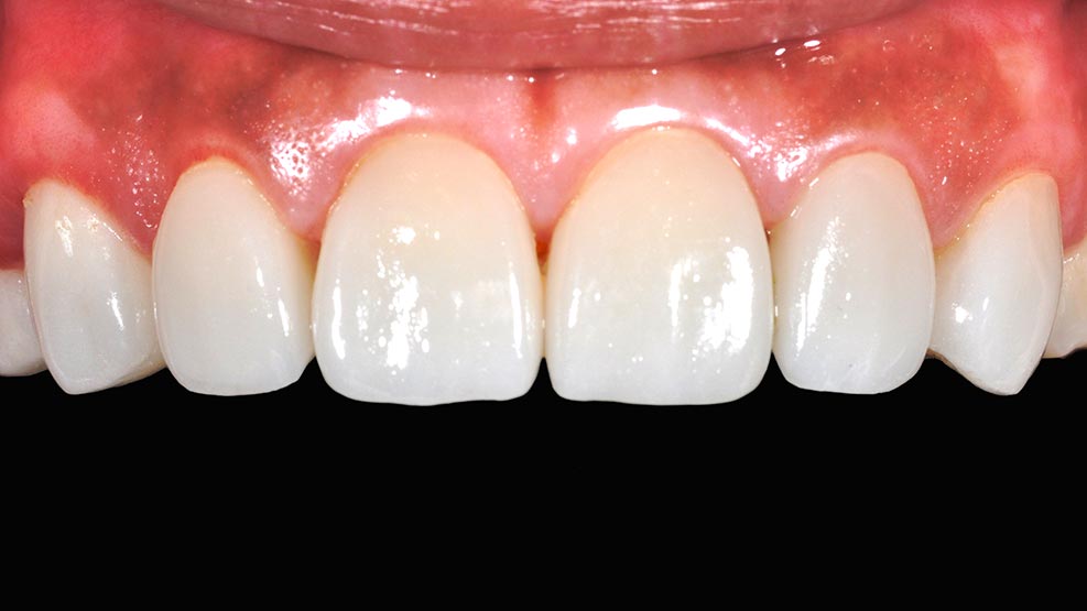 DSC_3843陶瓷貼片介紹6-全方位牙齒美學權威-張智洋醫師