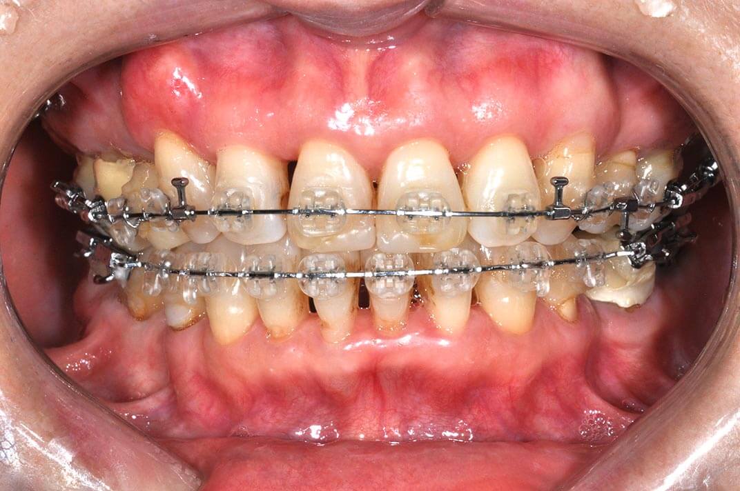 DSC_6227b-美容牙科-全方位牙齒美學權威-張智洋醫師