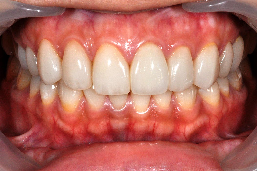 DSC_8024b-美容牙科-全方位牙齒美學權威-張智洋醫師