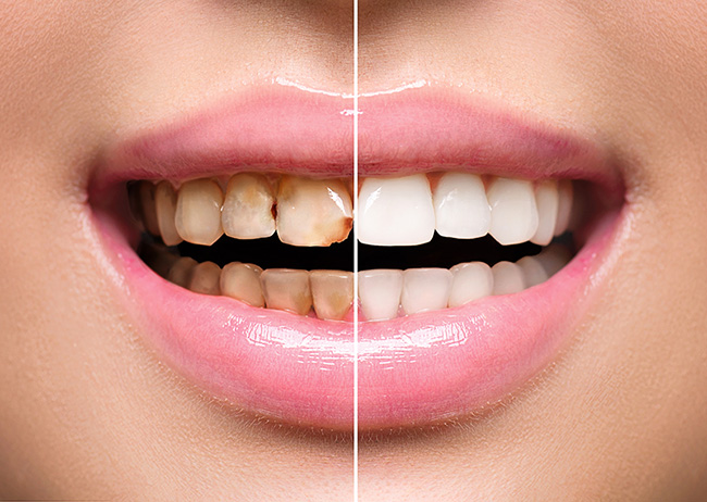 cosmetic-dentistry-美容牙科1-全方位牙齒美學權威 張智洋醫師