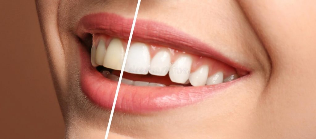 teeth-whitenin-牙齒美白3-全方位牙齒美學權威 張智洋醫師