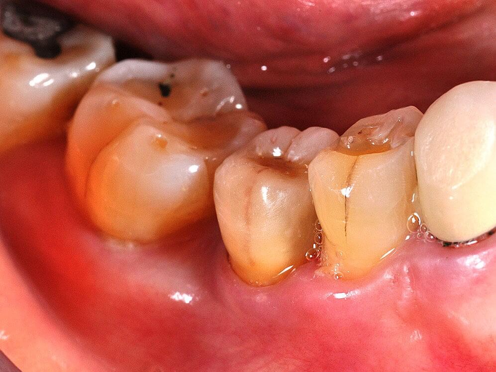 後牙植牙_2427b - 全方位牙齒美學權威 張智洋醫師 (2) (1)