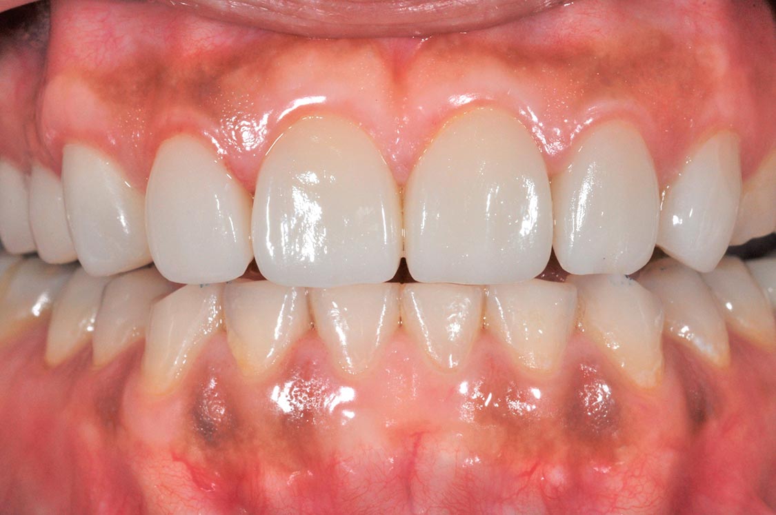 牙齒美容陶瓷貼片d-全方位牙齒美學權威-張智洋醫師