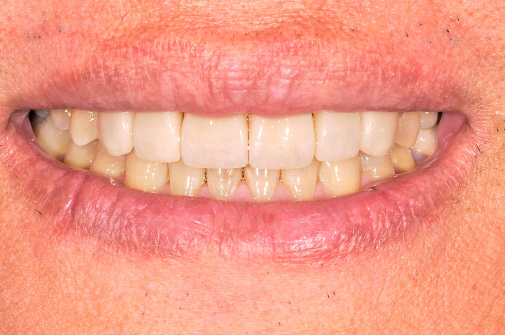 陶瓷貼片案例149b-after-全方位牙齒美學權威-張智洋醫師
