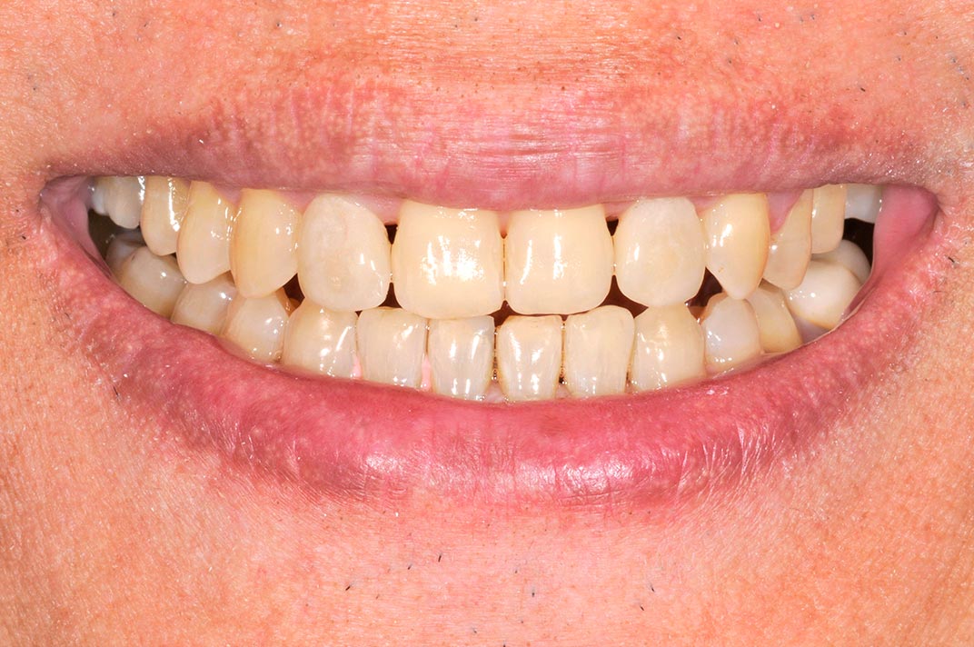 陶瓷貼片案例149b-before-全方位牙齒美學權威-張智洋醫師