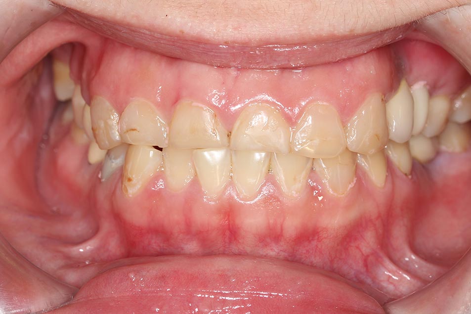 IMG_1026 (2)全口矯正+假牙重建2
