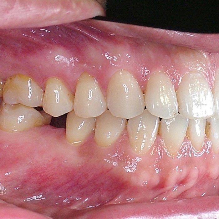 8牙齒矯正案例4-全方位牙齒美學權威-張智洋醫師