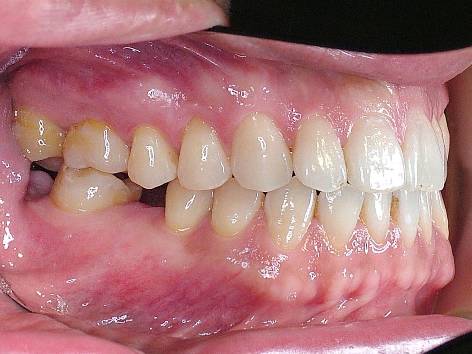 8牙齒矯正案例4-全方位牙齒美學權威-張智洋醫師