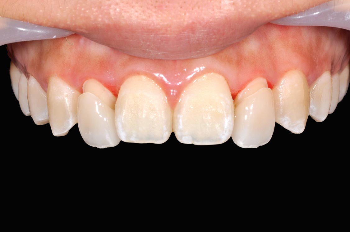 _DSC0057陶瓷貼片案例3-全方位牙齒美學權威-張智洋醫師