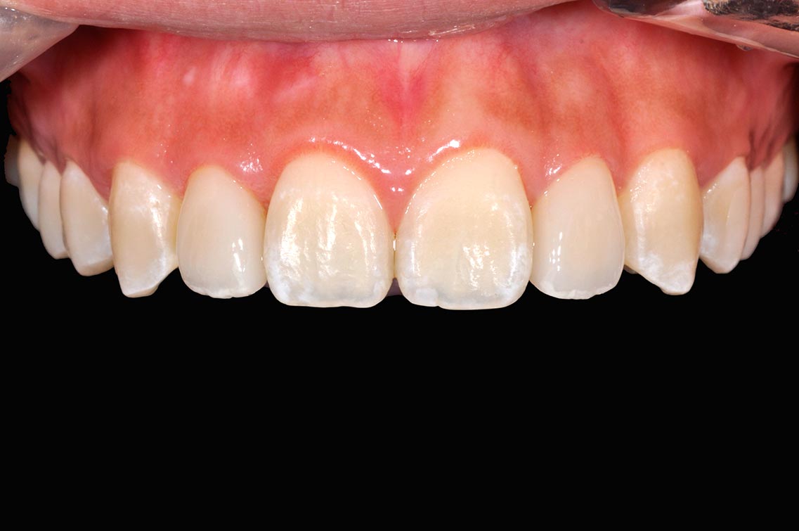 _DSC0091陶瓷貼片案例3-全方位牙齒美學權威-張智洋醫師