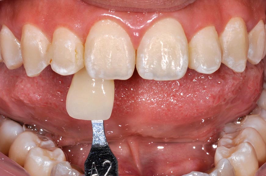 _DSC1066陶瓷貼片案例3-全方位牙齒美學權威-張智洋醫師