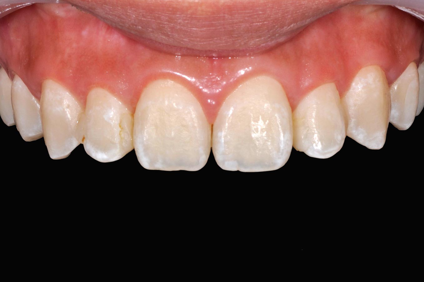 _DSC1068陶瓷貼片案例3-全方位牙齒美學權威-張智洋醫師