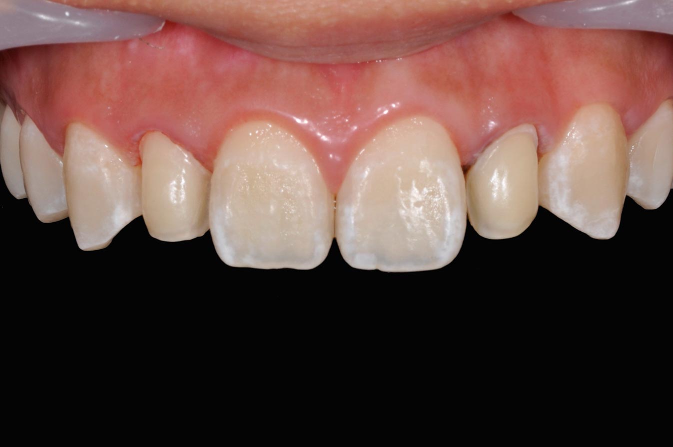 _DSC1075陶瓷貼片案例3-全方位牙齒美學權威-張智洋醫師