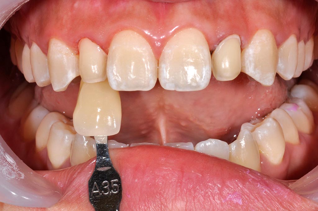 _DSC1076陶瓷貼片案例3-全方位牙齒美學權威-張智洋醫師