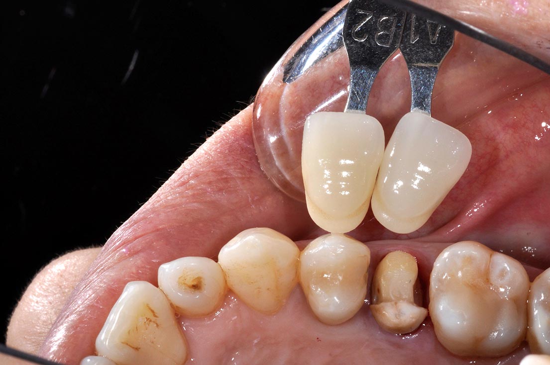 _DSC1178-3D齒雕-全方位牙齒美學權威-張智洋醫師