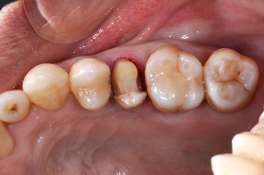 _DSC1179-3D齒雕-全方位牙齒美學權威-張智洋醫師