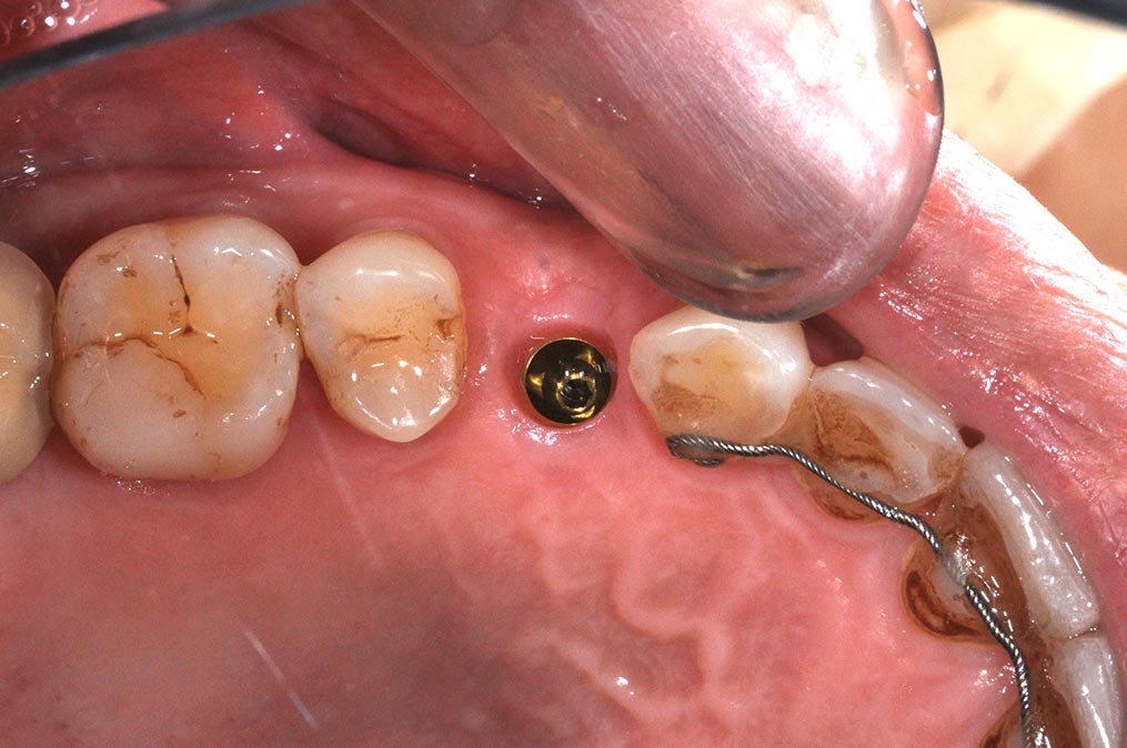 DSC_6670-小臼齒植牙2-全方位牙齒美學權威-張智洋醫師