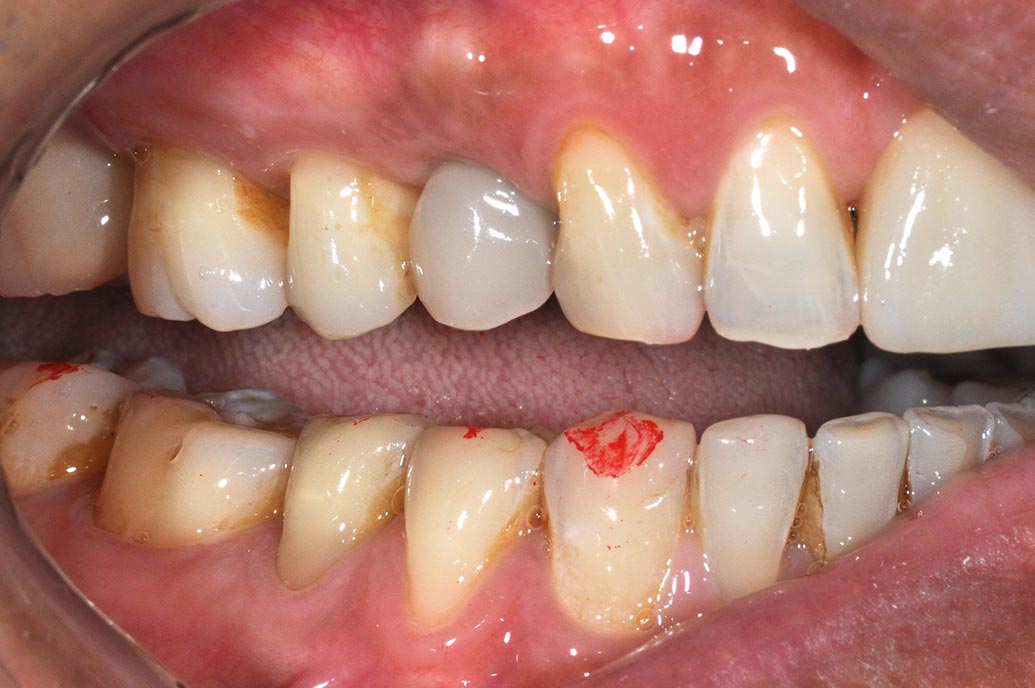 DSC_6674-小臼齒植牙2-全方位牙齒美學權威-張智洋醫師