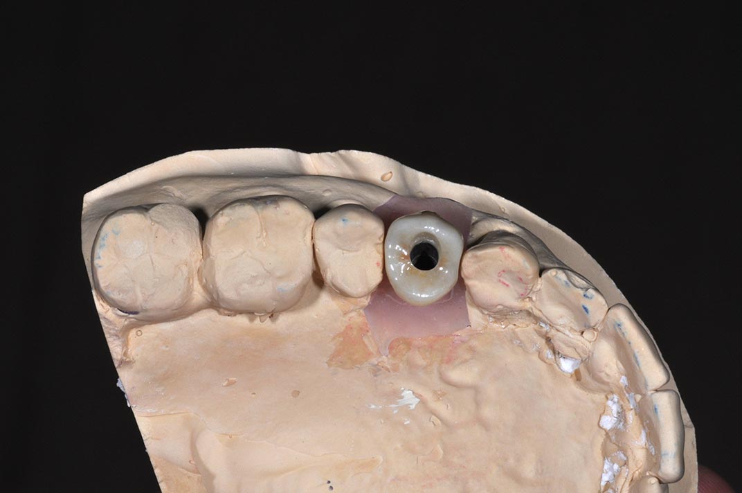 DSC_7333-小臼齒植牙2-全方位牙齒美學權威-張智洋醫師