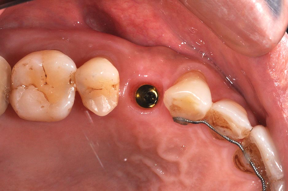 DSC_7341-小臼齒植牙2-全方位牙齒美學權威-張智洋醫師