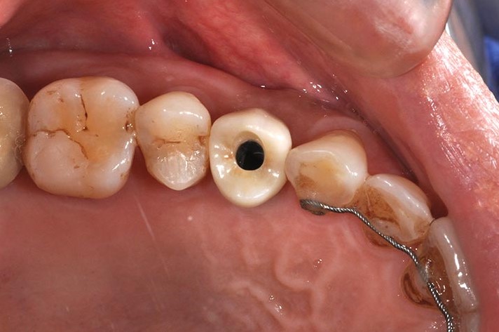 DSC_7342-小臼齒植牙2-全方位牙齒美學權威-張智洋醫師